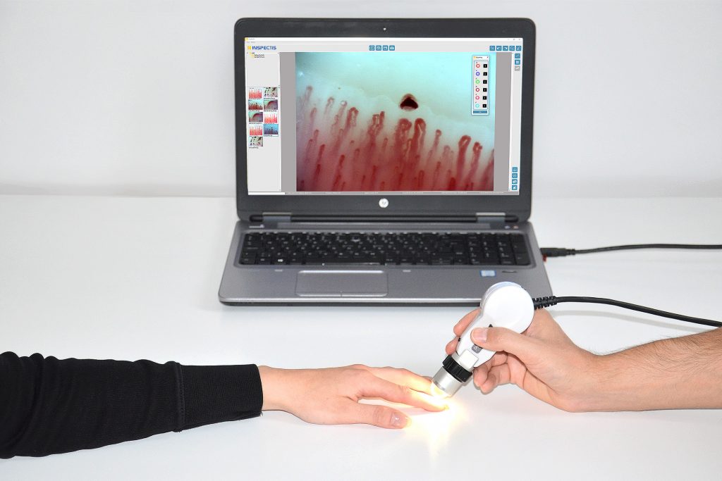 Exploracion capilaroscopio