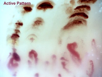 capillaroscopy-Active-pattern