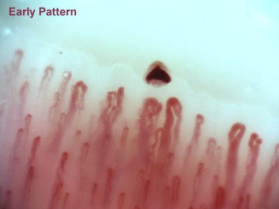capillaroscopy-Early-pattern