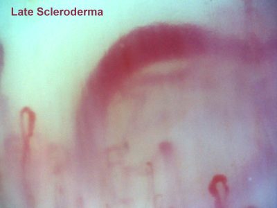 capillaroscopy-Late-scleroderma