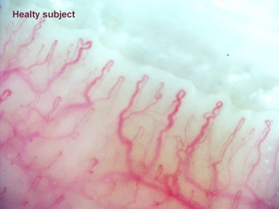 capillaroscopy-healty-subject